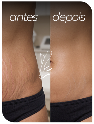 antes e depois estrias